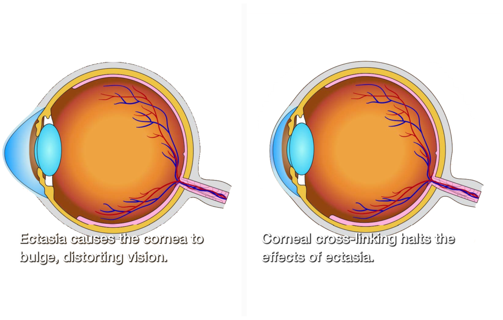 The Science Behind Corneal Cross-Linking & Top 4 Alternatives to LASIK