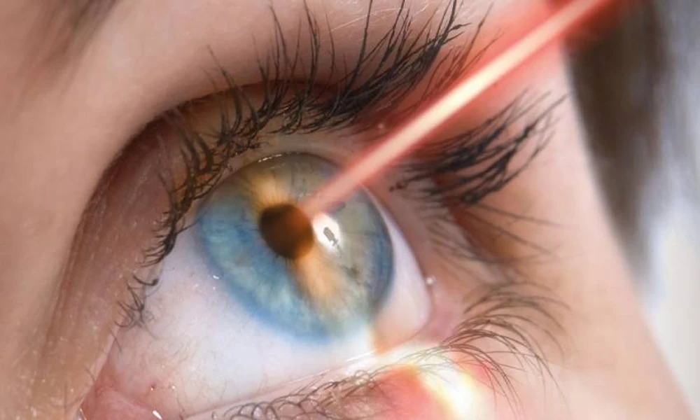 What to Know Before Considering LASIK Eye Surgery